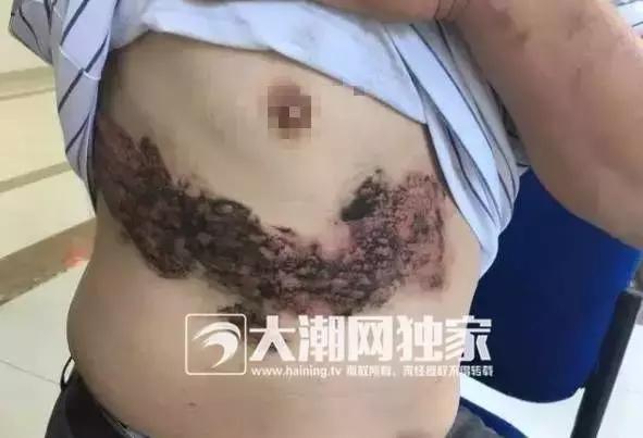 3岁孩子被扎针眼,男童脖子上惊现10厘米伤口