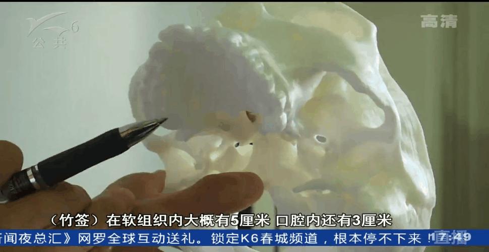 吃烤肠被竹签刺穿咽喉，医生：如果再刺深一点，孩子可能就当场死亡了