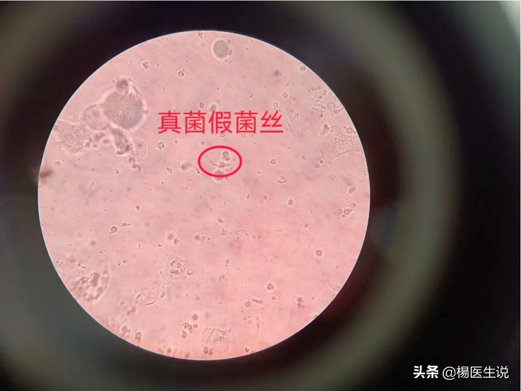 滴虫性阴道炎和霉菌性症状区别,滴虫性阴道炎和霉菌性症状表现