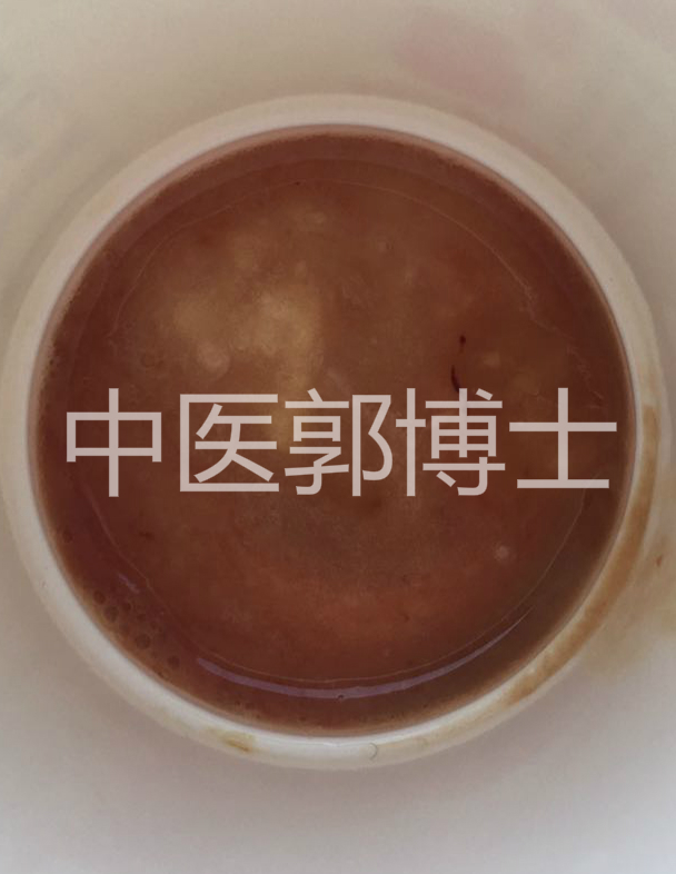 咳嗽咳出褐色石头,咳吐白色粘痰吃什么药