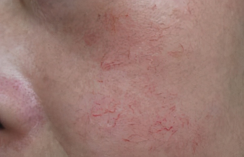 脸部红血丝怎么去除有效,脸部红血丝该怎样祛除呢