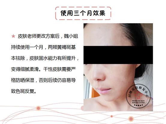 孕妇长斑修护产品,孕妇长斑怎么办用什么可以祛斑