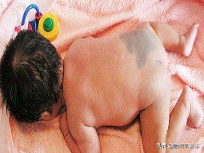 青胎记成因症状及危害科普,背中间靠左青胎记代表什么