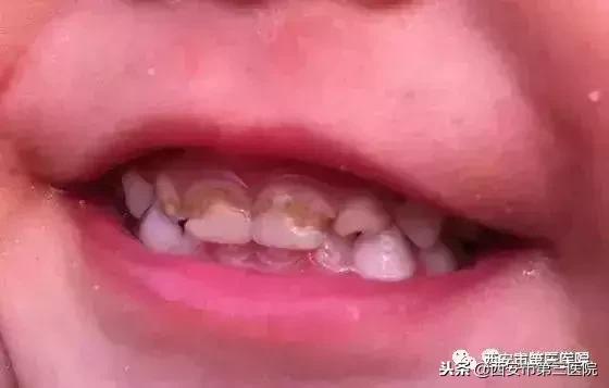 宝宝门牙变黑了怎么补救,孩子从小爱美好不好