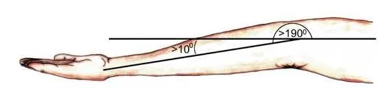 女性肘超伸,肘超伸锻炼危害