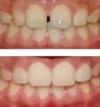 牙齿黑三角怎么补救,牙齿上的黑三角怎么改善