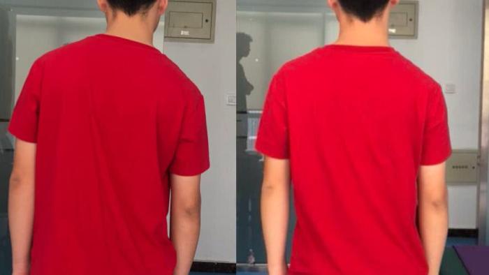 高低肩体态不好可以去练普拉提,高低肩腰间盘突出体态怎么矫正