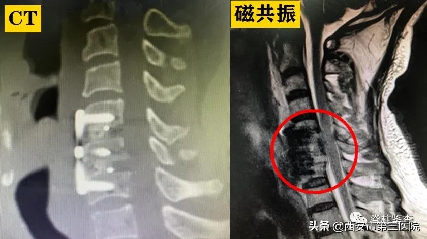 颈椎病减压手术安全么,手术脊髓减压