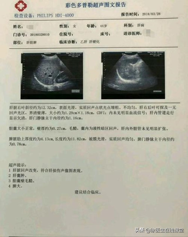 肝硬化消化道出血静脉曲张的治疗,肝硬化静脉曲张出血治疗原则