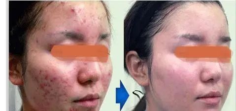 火针治疗淀粉样皮肤病有效吗,引火烧身免费全文