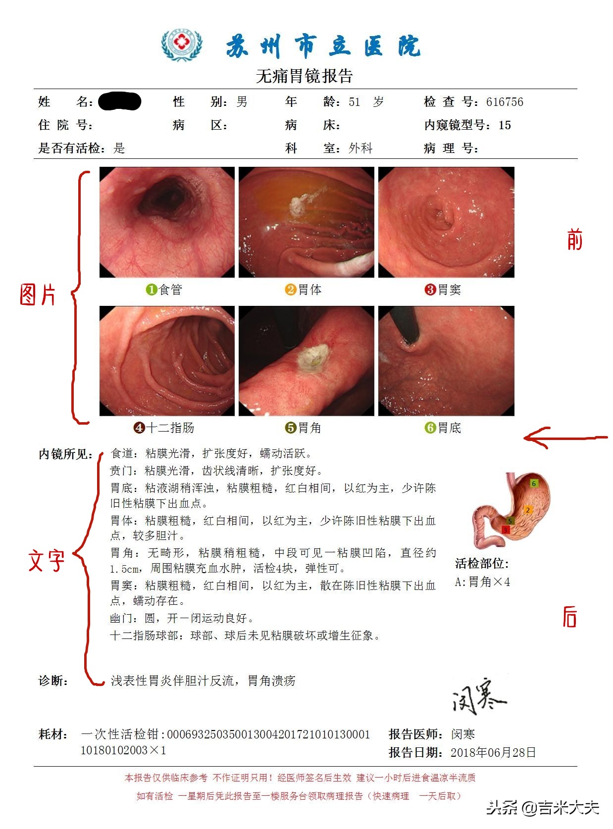 做完胃镜检查我的胃烂了一点,做完胃镜拿了报告怎么拿药