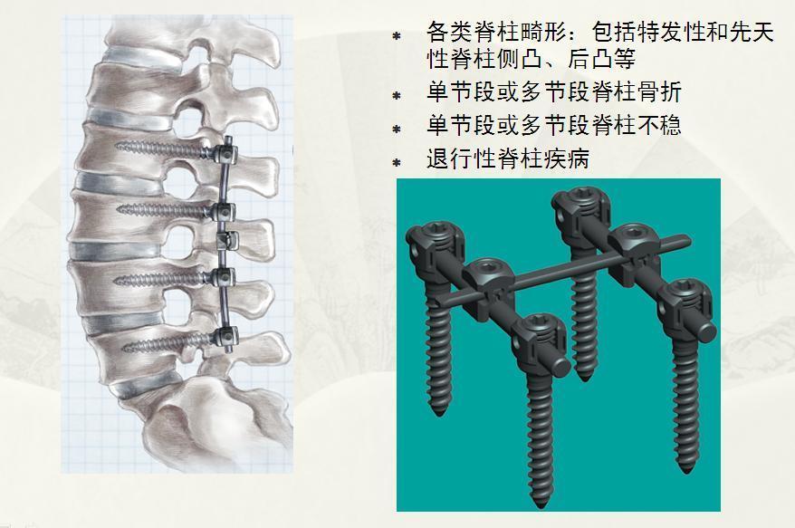 腰椎间盘突出针灸能治彻底吗,腰椎间盘突出针灸治疗能彻底吗