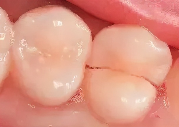 牙齿咬东西酸软无力用什么牙膏,牙齿酸软恢复小妙招真的有用吗