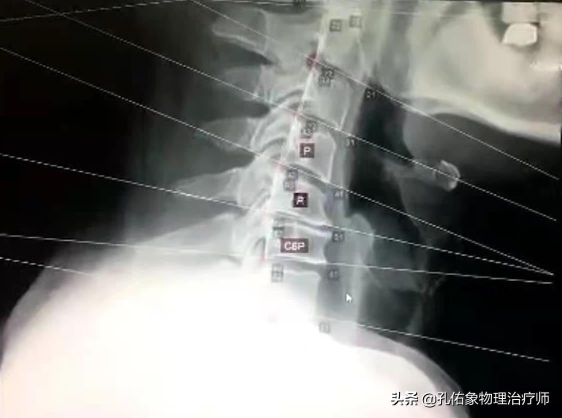 肩膀疼痛也不是肩周炎是怎么回事,肩周炎肩膀疼痛4个方法