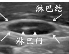 甲状腺术后见异常淋巴结什么意思,甲状腺术后病理有淋巴结转移2枚