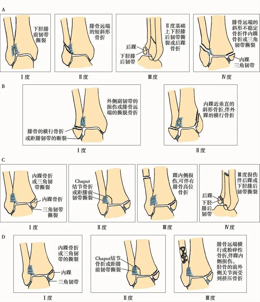 儿童踝关节骨折分型,收藏踝关节骨折的常见分型