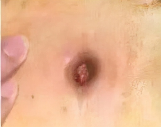 肚脐眼漏尿百万分之三的概率被小伙撞上了