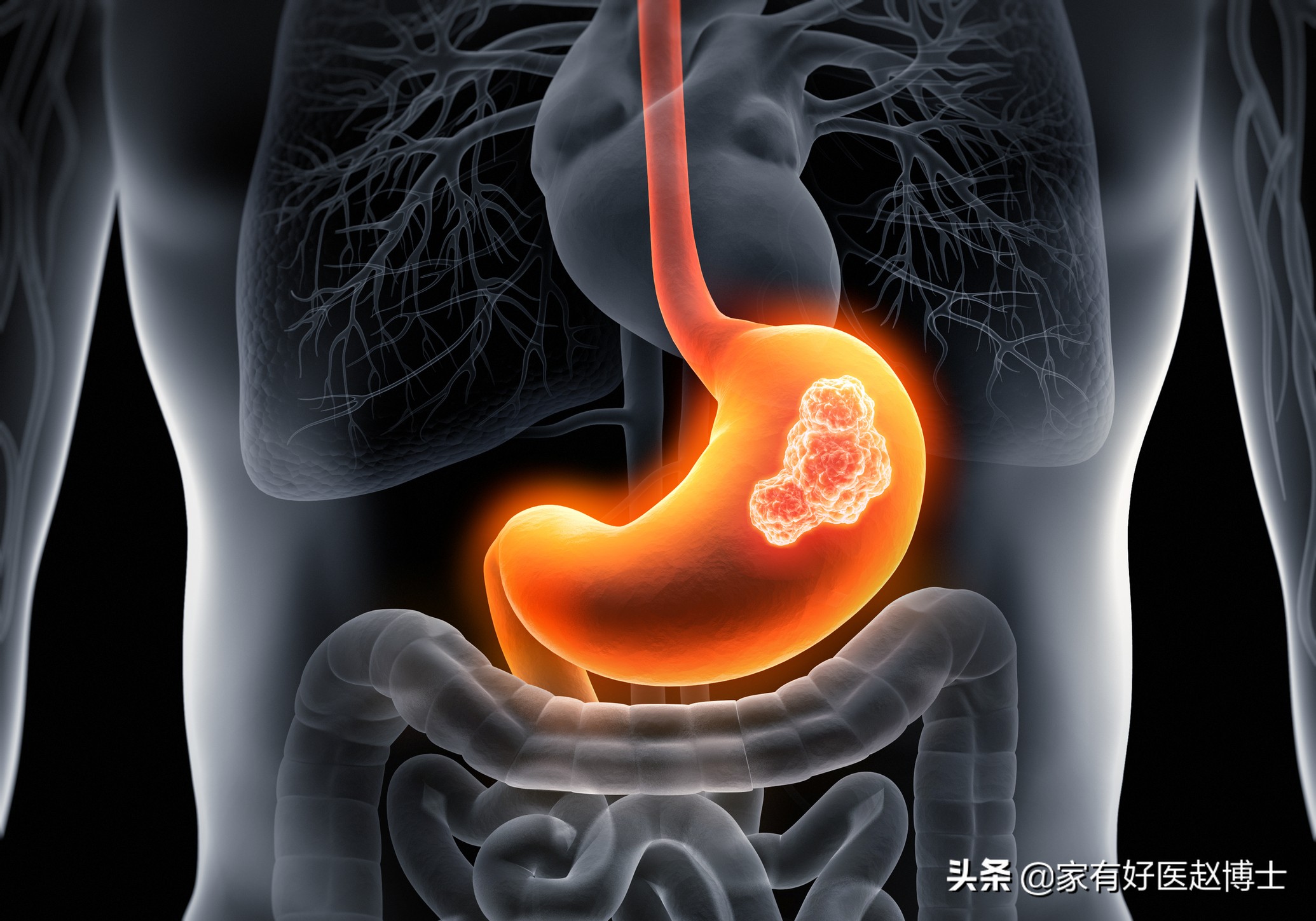 最常见5类息肉每个人都可能有，哪些无癌变风险，哪些需要切除？