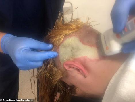 烧伤植皮头发,女孩漂发烫伤头皮后续