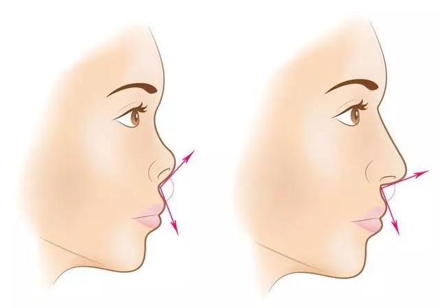 鼻型修容怎样修看着干净,蒜头鼻朝天鼻怎么修容