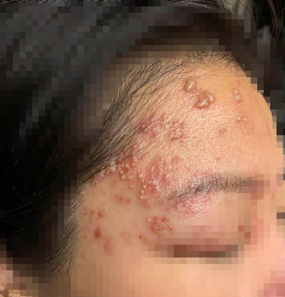 疱疹后遗神经痛针灸可以治愈吗,疱疹涂了药膏感觉更加严重了