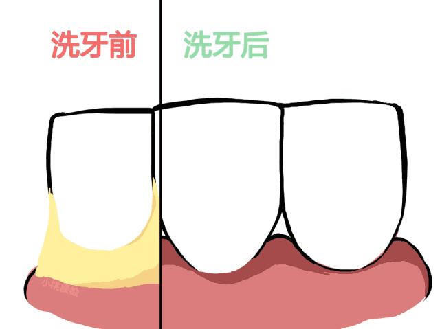 儿童牙齿变黄怎么美白,牙齿为什么会变黑该怎么改善