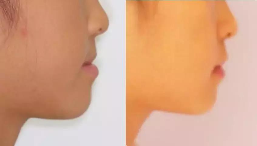 动画模拟牙齿矫正前后会变美,做了矫正牙齿会反弹吗