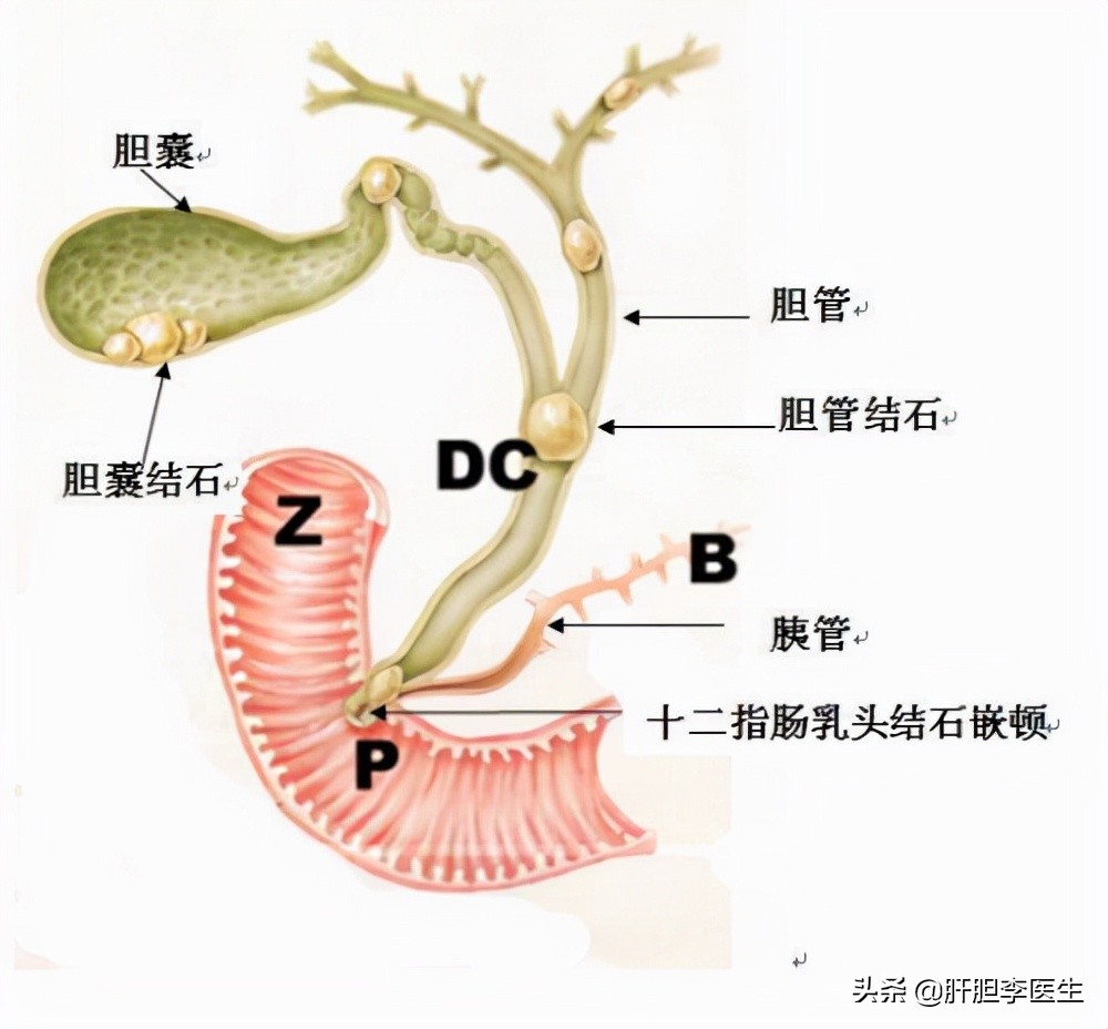胆囊结石大的好还是小的好,胆囊结石和肾结石哪个比较严重