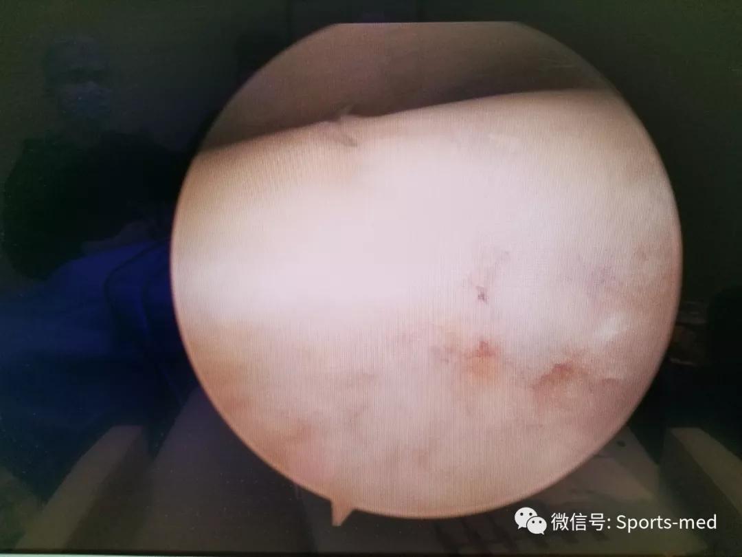 距骨软骨损伤的关节镜治疗,距骨软骨损伤关节镜手术