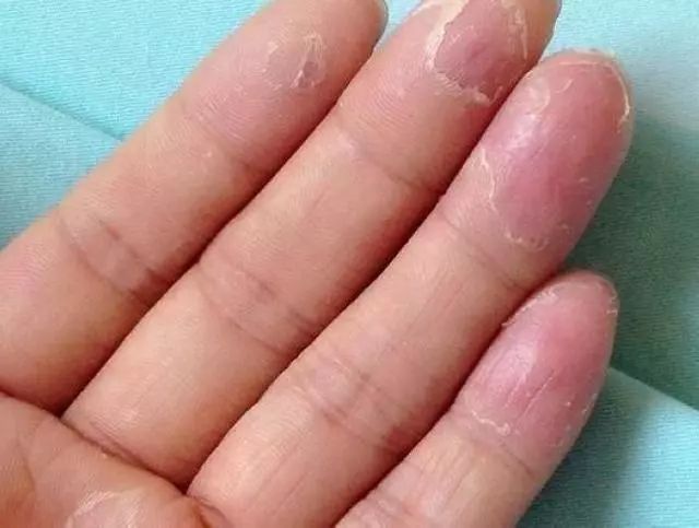 皮肤科医生手总脱皮怎么办,皮肤科张教授手脚脱皮
