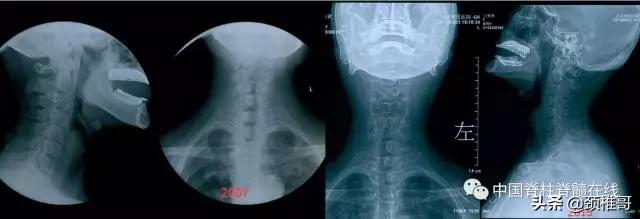颈椎病的护理临床路径流程图,颈椎病的健康管理与康复指导