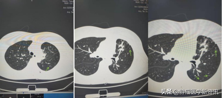 肺癌早期的6个信号中医治癌,肺癌正确的抗癌方法