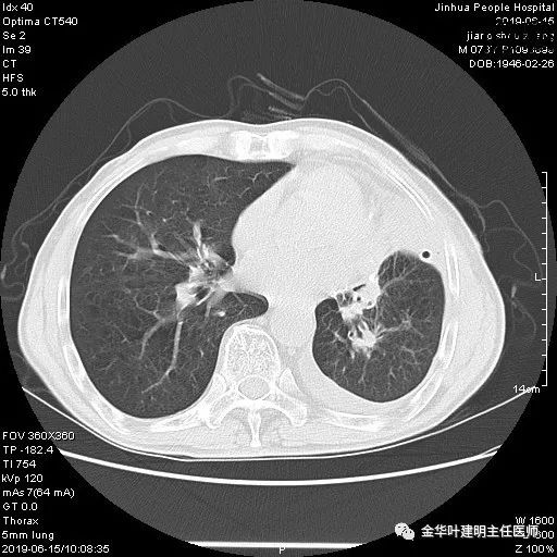 手术引起乳糜胸,有没有做了肺结节手术后是误诊的