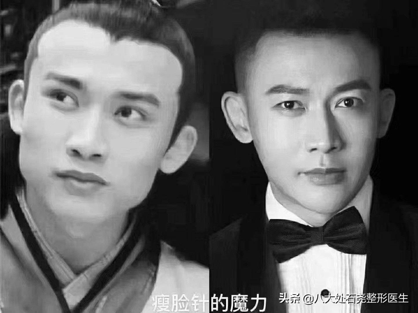 瘦脸针后苹果肌下垂凹陷能恢复吗,你有脸部下垂的烦恼吗