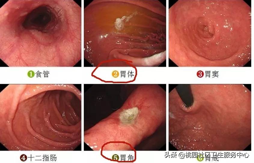 手把手教你：3分钟看懂胃镜报告