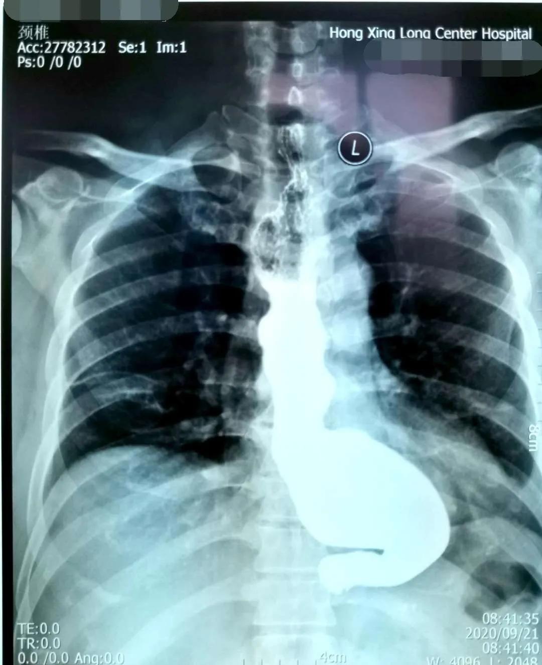 内镜下贲门失弛缓症微创手术,贲门失弛缓内镜治疗