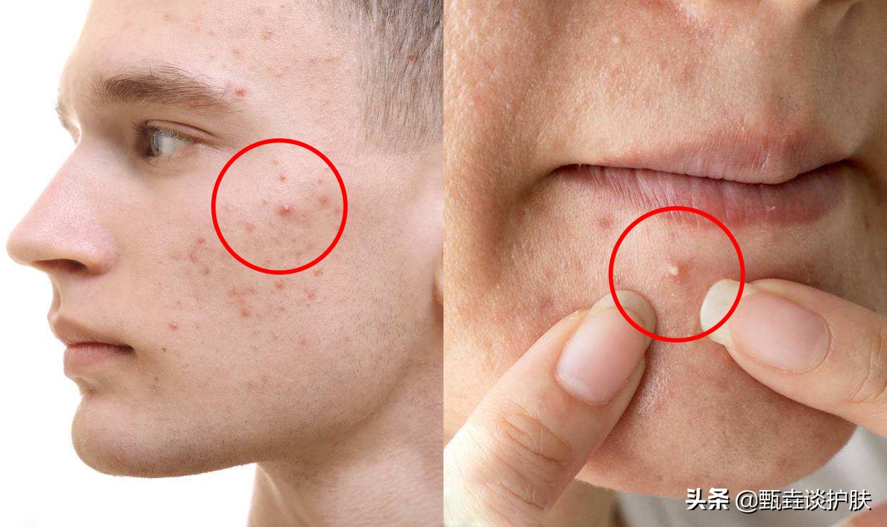 痘痘越挤越大越硬,痘痘黄了要不要挤
