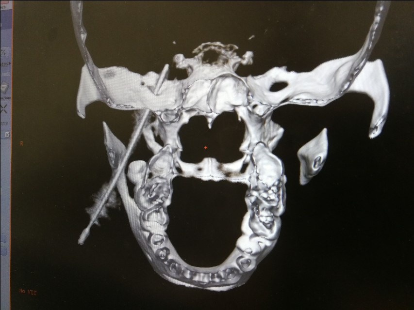 三叉神经痛射频热凝术有效吗,三叉神经痛球囊和射频哪个好
