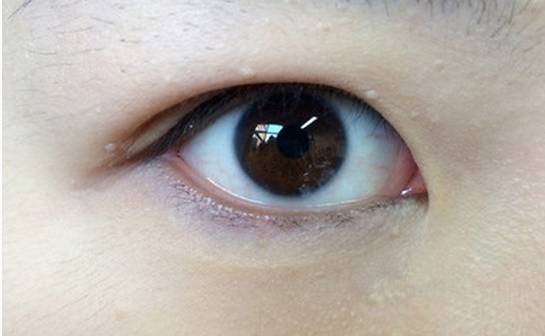 内双也算单眼皮吗,s型双眼皮贴小内双变成大内双