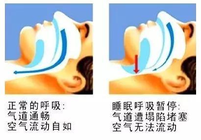 睡觉老是打鼾是不是有什么病,睡觉爱打呼噜是什么原因导致