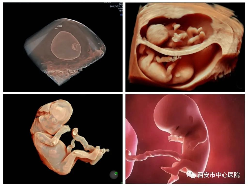 胎儿畸形筛查超声,胎儿系统性畸形筛查