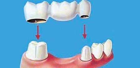 单颗牙缺失的修复方法,单颗牙缺失最好办法
