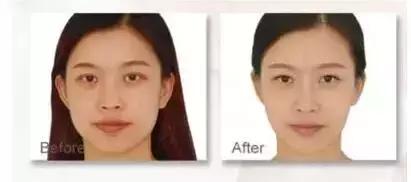 解密瘦脸针的几大常识性问题,关于瘦脸针的真实事件