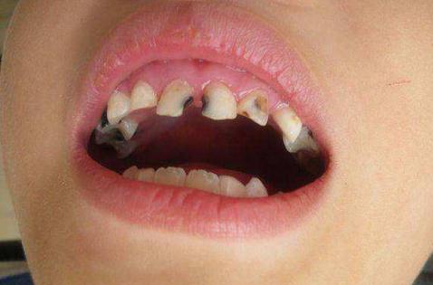 给孩子补个牙,竟花了两万多