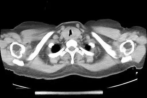 高位气管淀粉样变的处理|王洪武