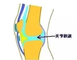 滑膜炎是怎样引起的需要注意哪些,滑膜炎并发症最严重的是什么