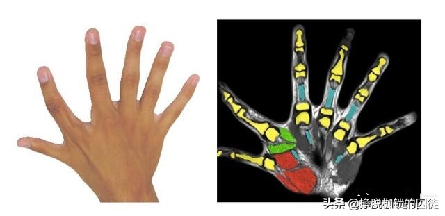 六指一般多出哪一个手指,六指多出的手指叫什么