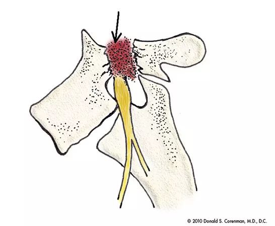 椎弓崩裂怎么知道是先天还是后天,椎弓崩裂的原理