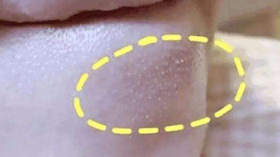 手动去脂肪粒工具,去脂肪粒神器排行榜