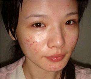 满脸粉刺皮肤油腻不堪，5个方法轻松解决，素颜也像化了妆一样